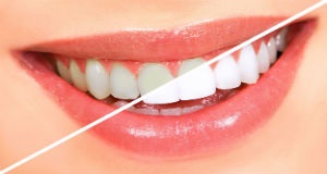 Teeth Whitening Treatment in India